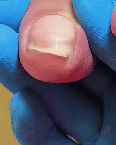 Cortaúñas Milagroso para Uñeros